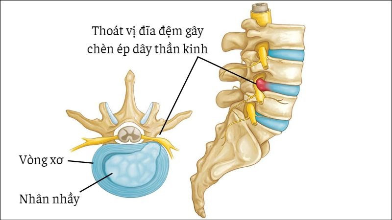 Tdoctor- Dấu hiệu và sự huy hiểm của thoát vị đĩa đệm